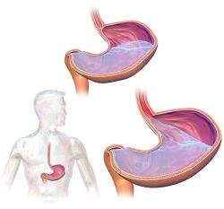 Acid Reflux GERD illustration