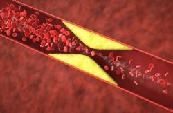 Atherosclerotic Plaque illustration