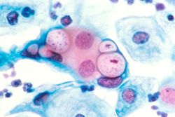 Chlamydia in pap smear illustration