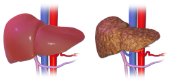 Normal liver vs. liver cirrhosis illustration