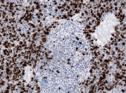 Medulloblastoma Infographic Overview and Clinical Essentials