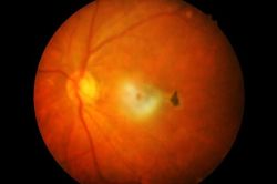 Retinal Detachment illustration