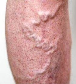 Varicose veins on leg illustration