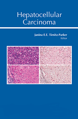 Hepatocellular carcinoma  book cover